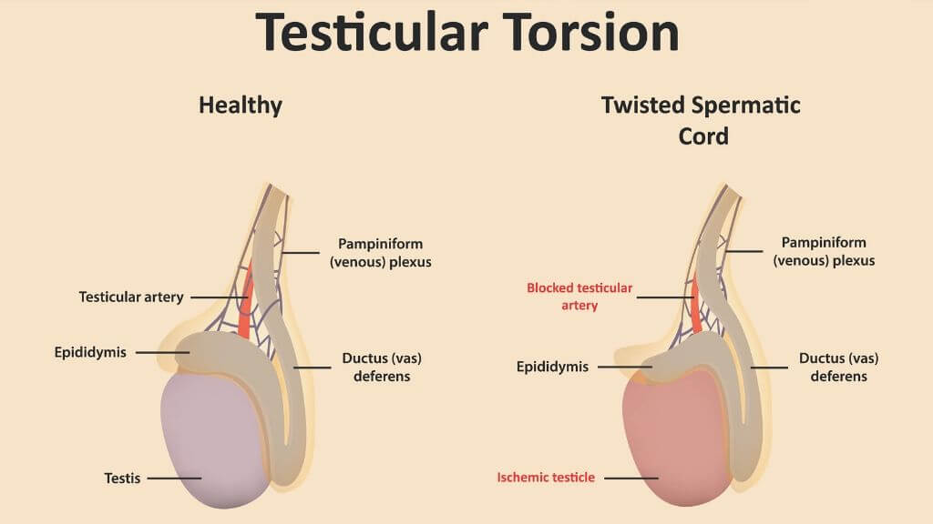 Torsion Testis