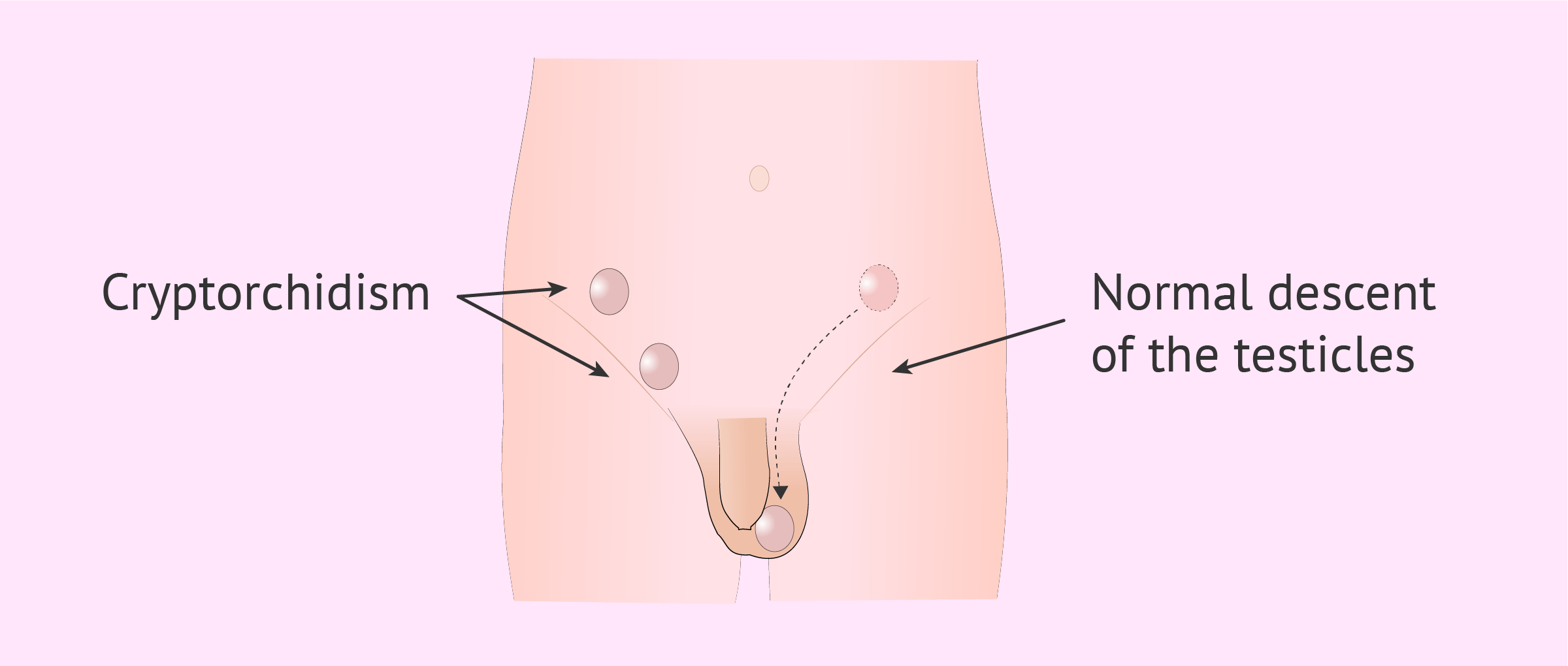 Undescended Testis