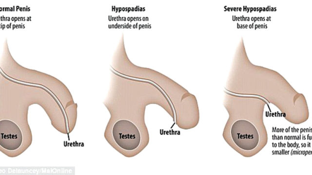 Hypospadias